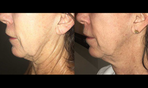 Laser Skin Tightening Before After Mississauga Oakville
